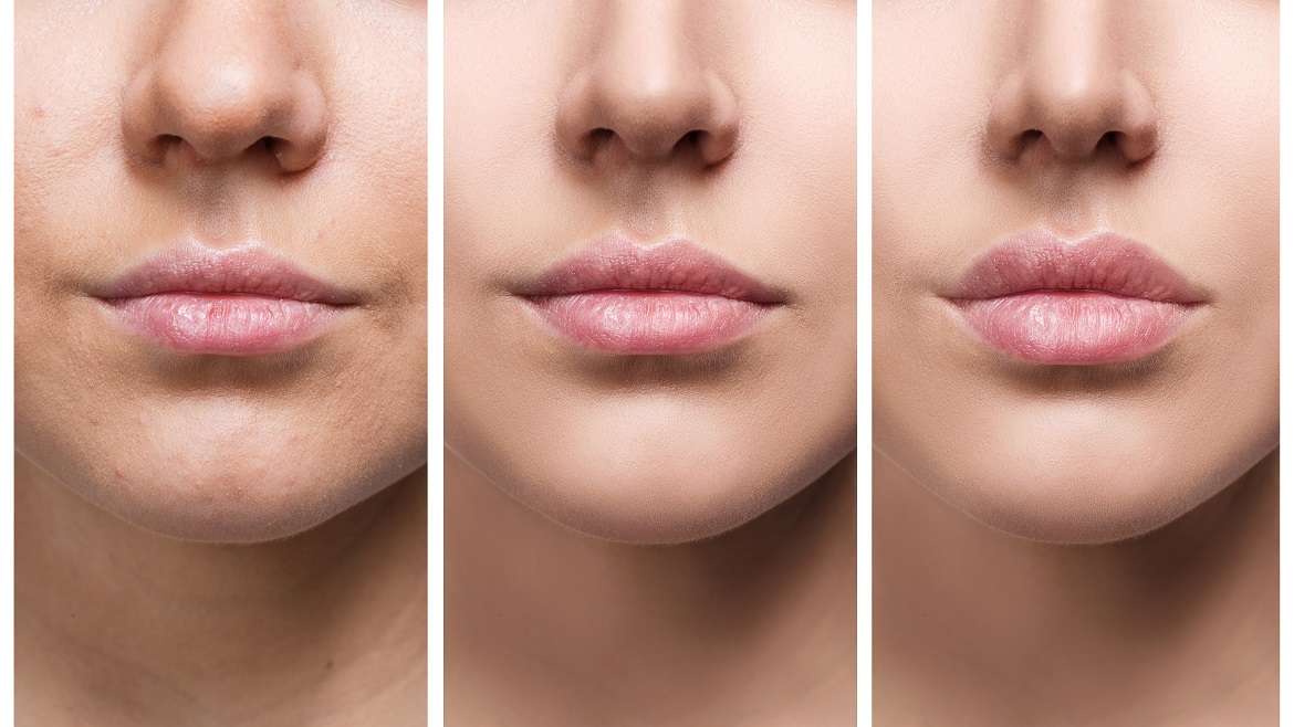 lip filler c'est quoi Comblement des lvres : les mythes dmystifis Lip Fillers - La Beaut